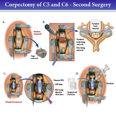 Corpectomy