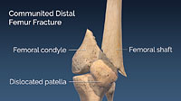 Comminuted Distal Femur Fracture