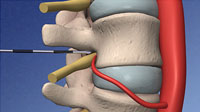 Placement of epidural needle