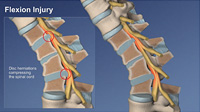 Flexion Injury