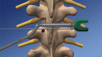Pedicle Screw Placement