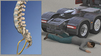 Lumbar Spine Crush Injury
