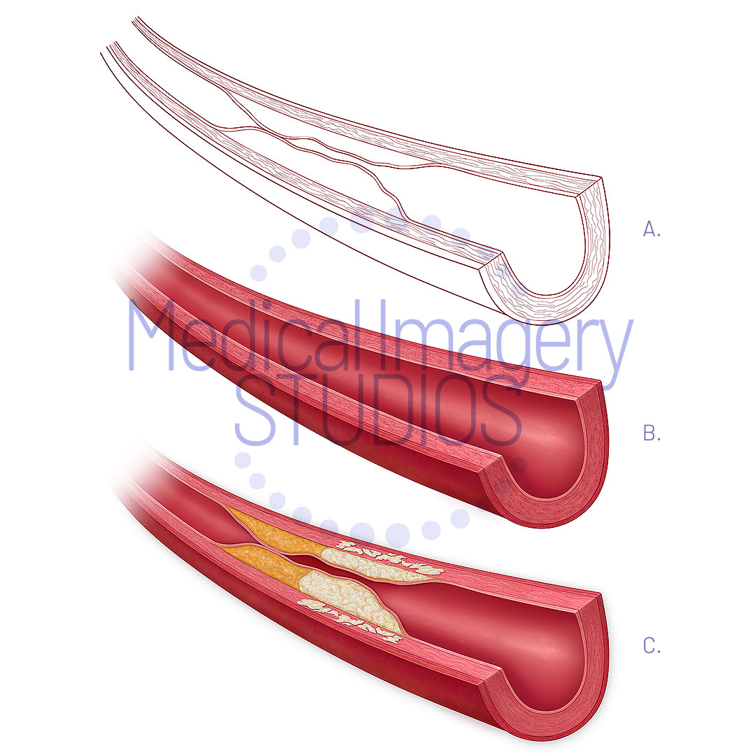 Arterial Calcification