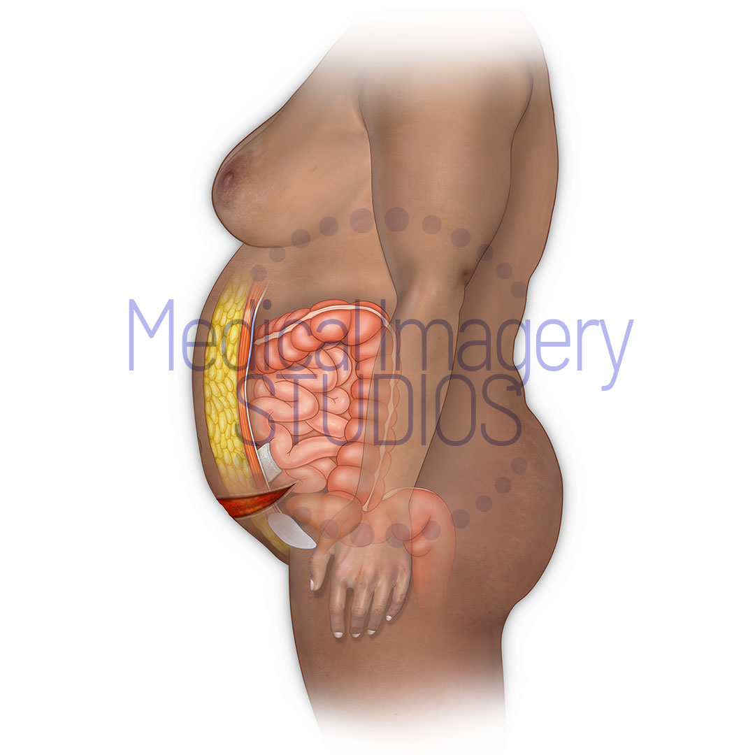Caesarean Section