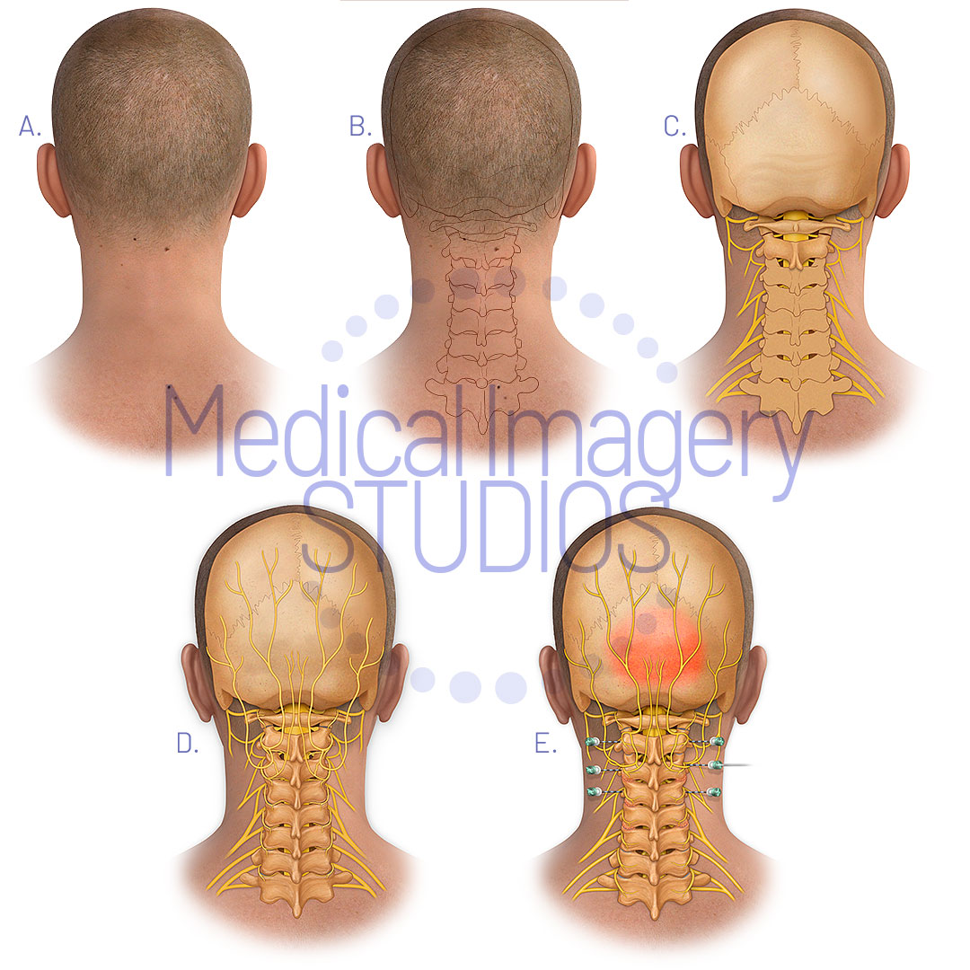 Cervical Medial Nerve Injection steps
