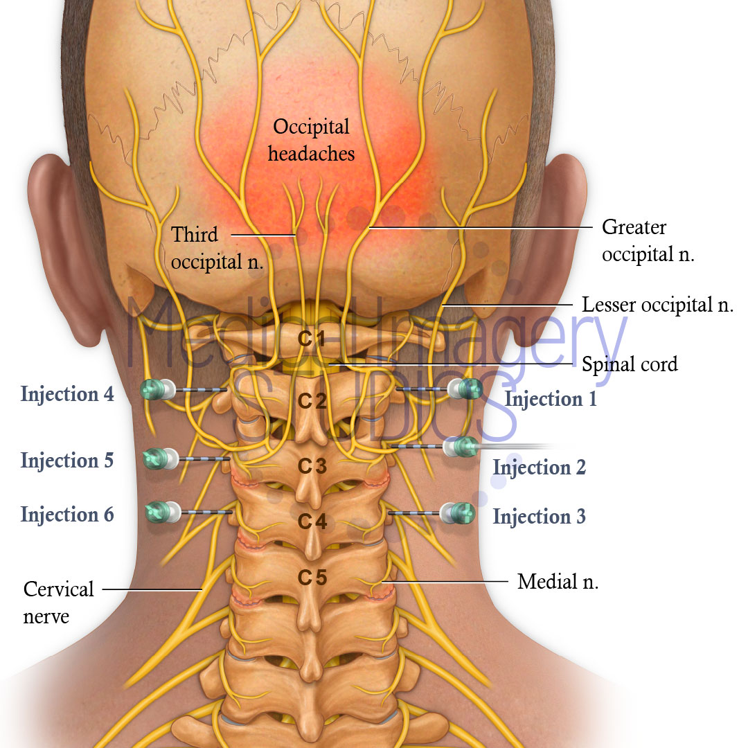 Cervical Medial Nerve Block