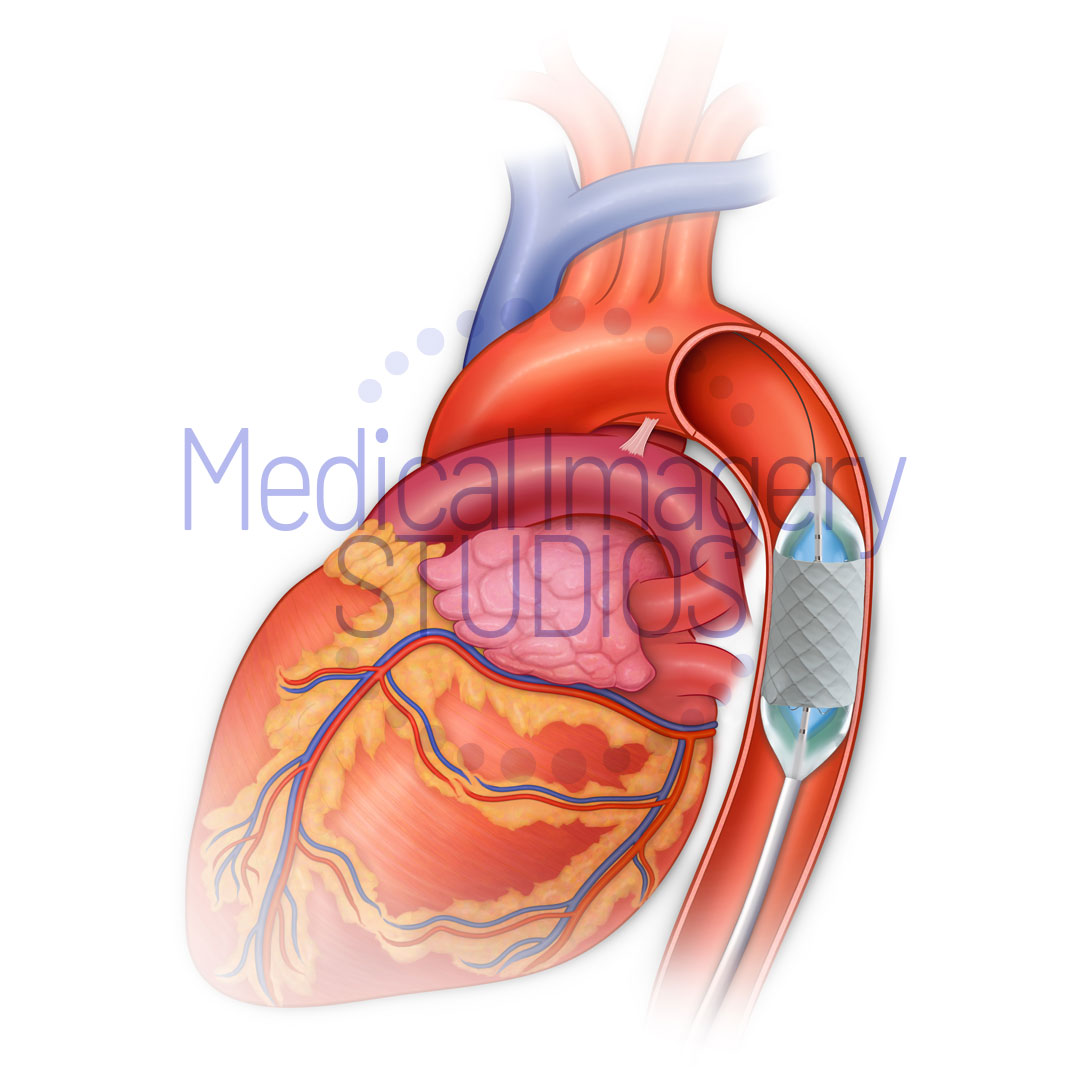 Coarctation Stent