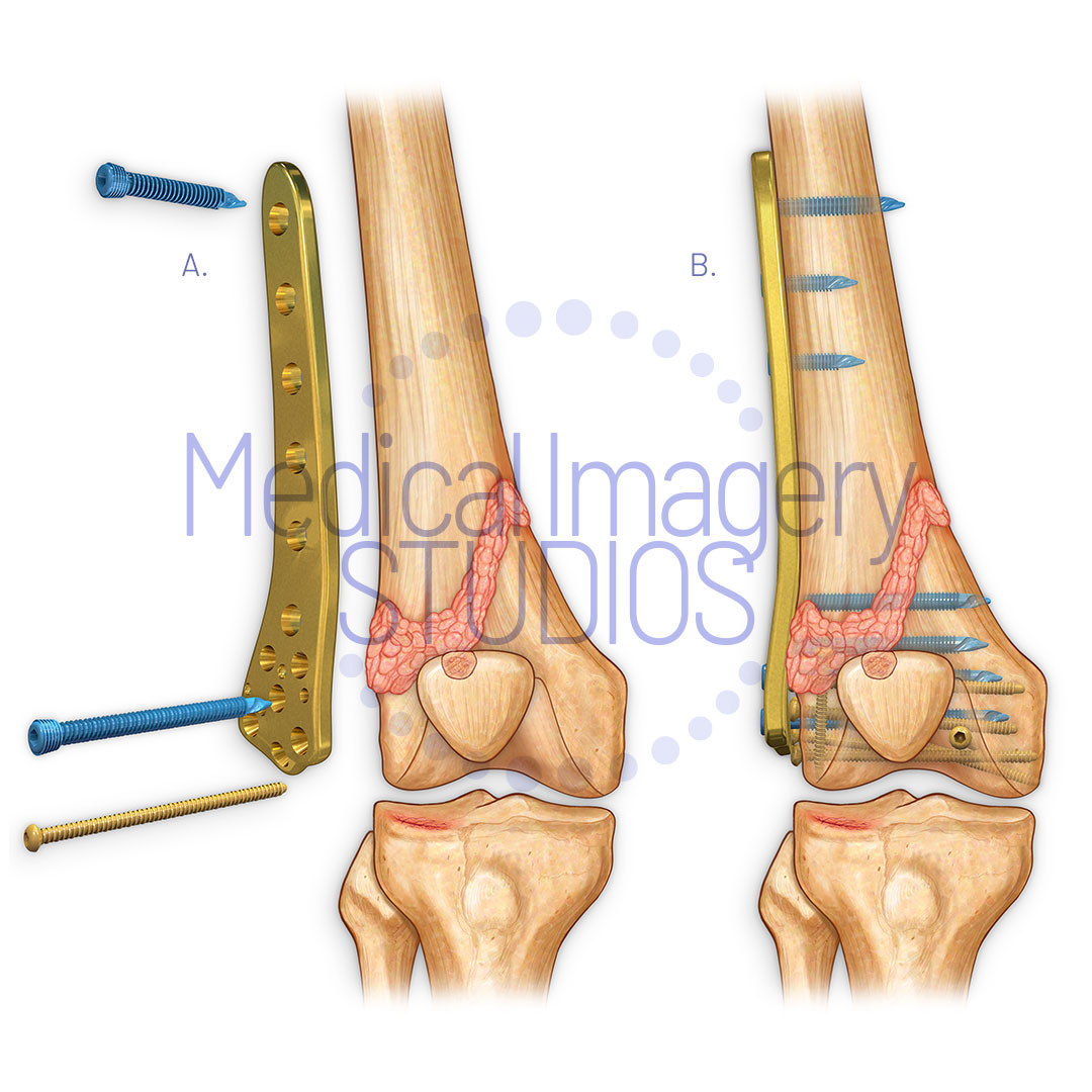 Compound Fracture Plate