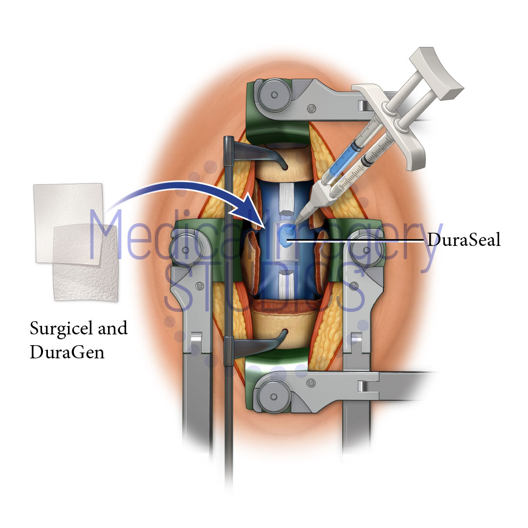 Duracel and DuraGen seal Spinal Cord Dura