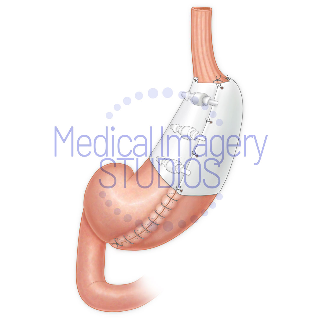 Gastric Vest