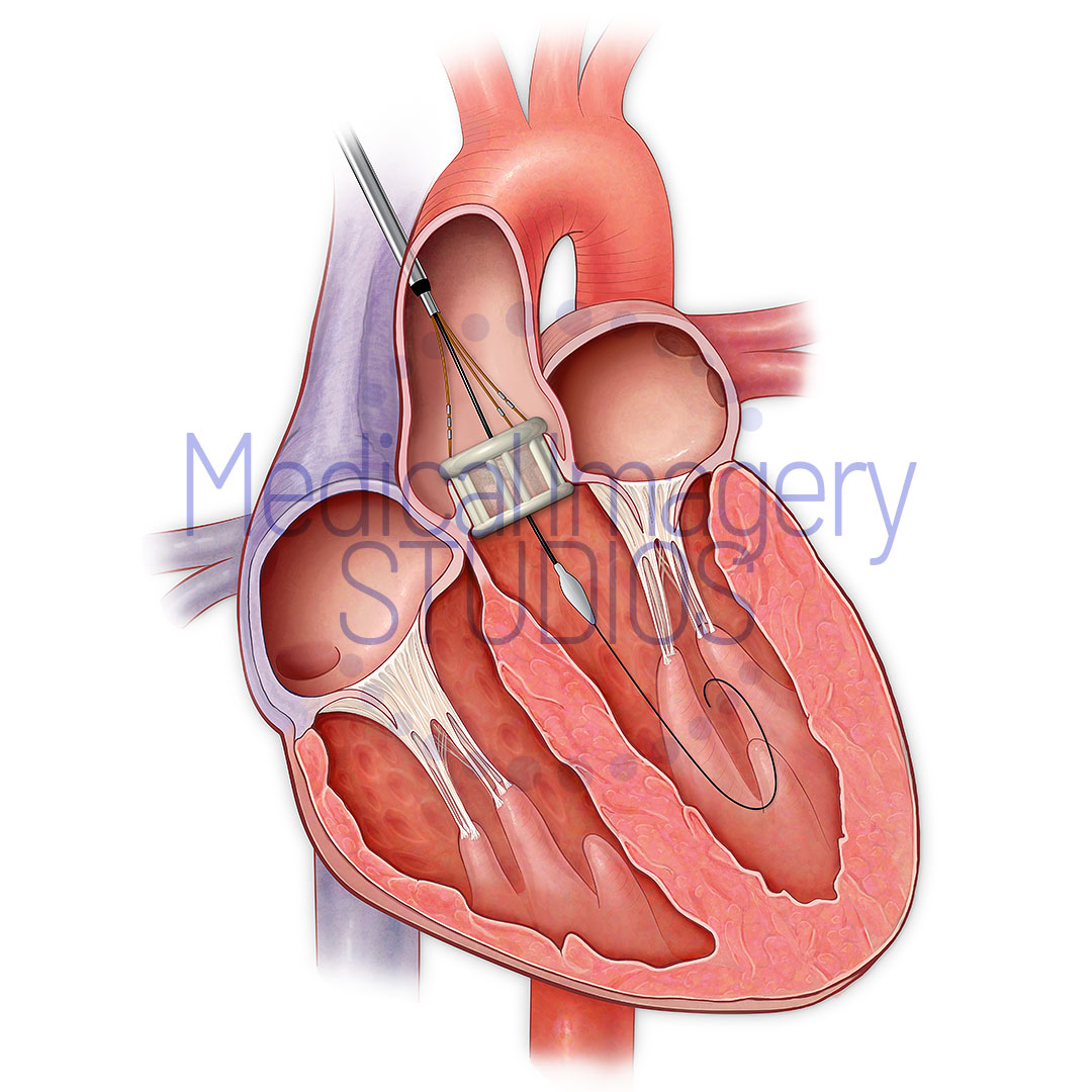 Aortic Heart Valve