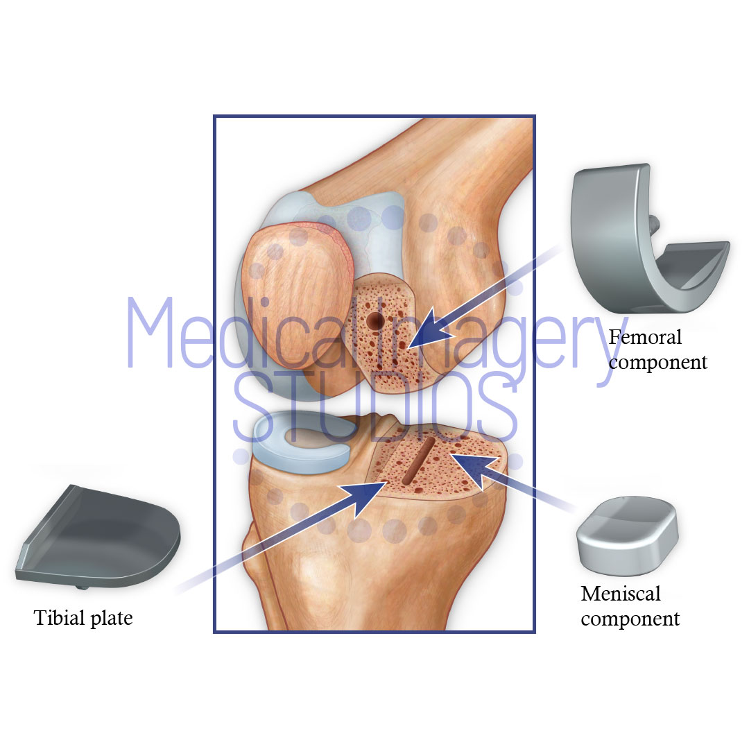 Hemi-Knee Replacement Components