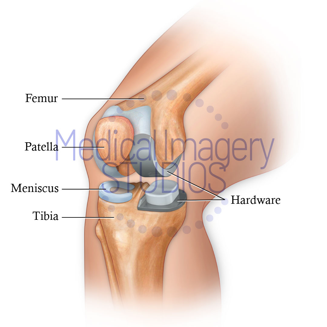 Hemi-Knee Replacement