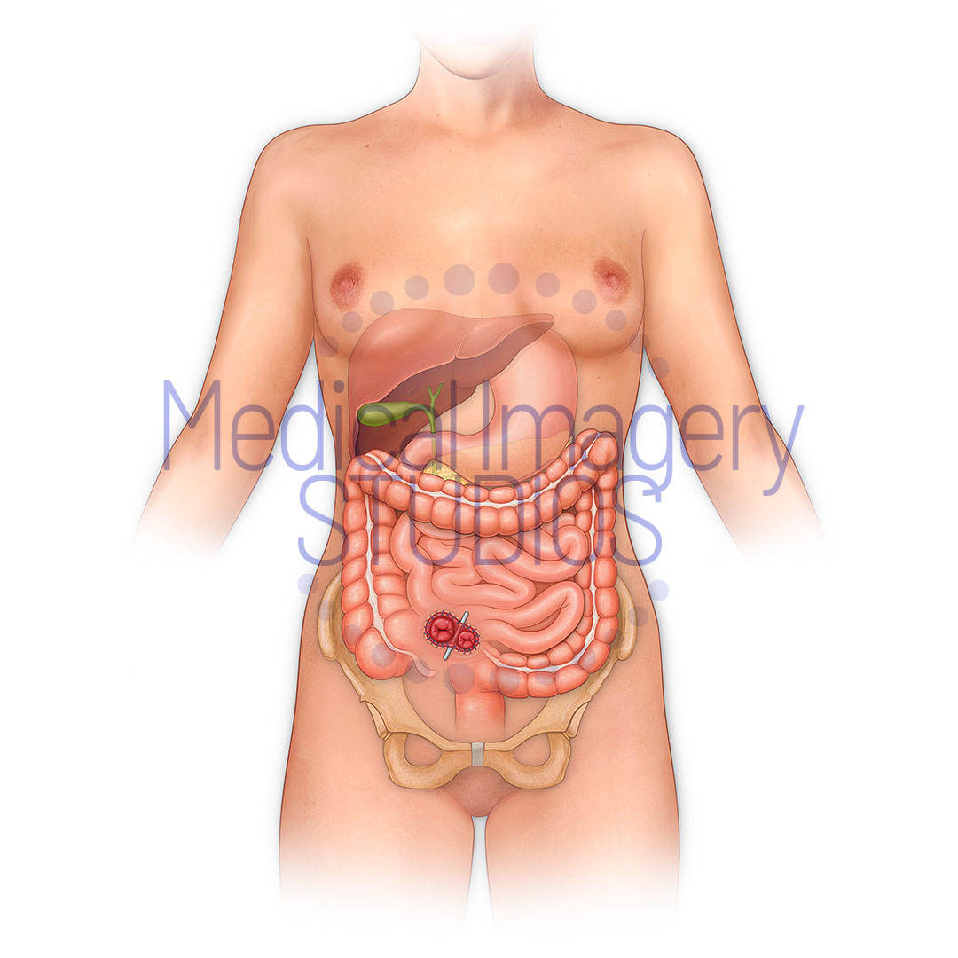Ileostomy