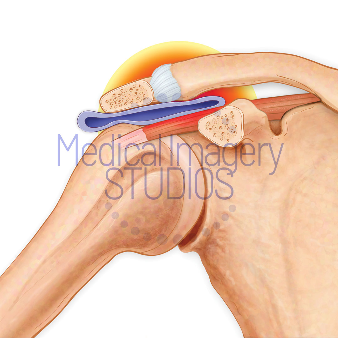 Impinged Shoulder Bursa