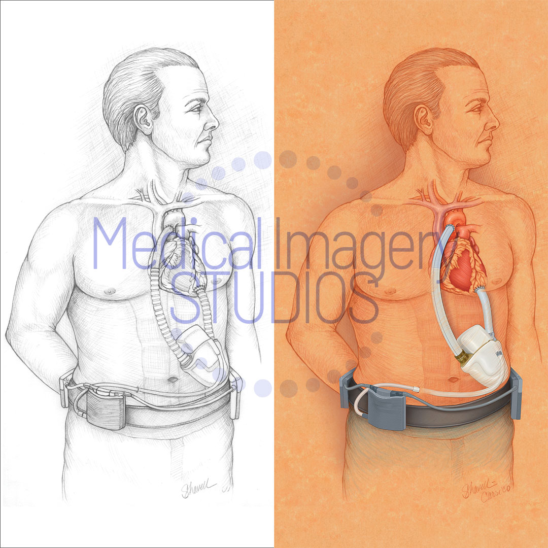 Left Ventricular Assist Device (LVAD)