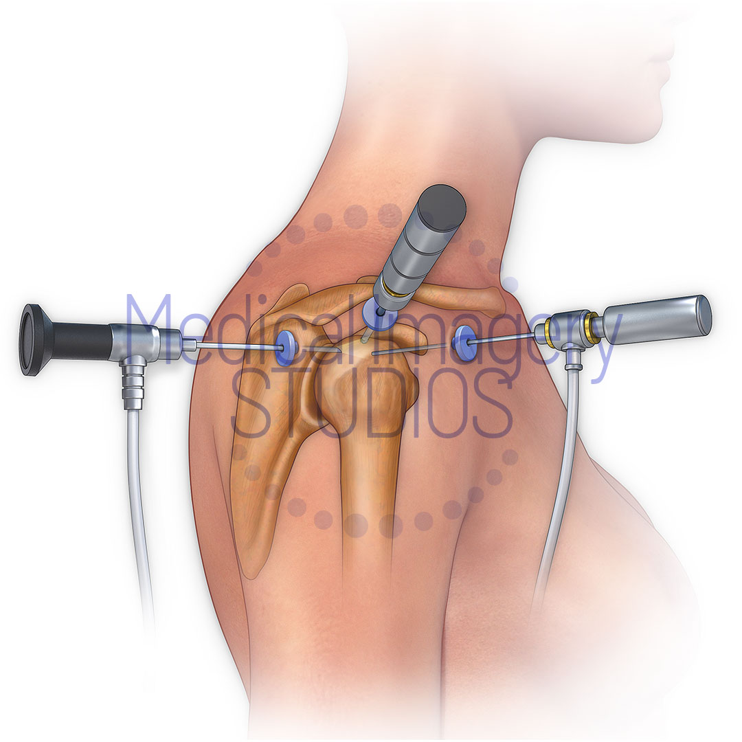 Shoulder Arthroscopy