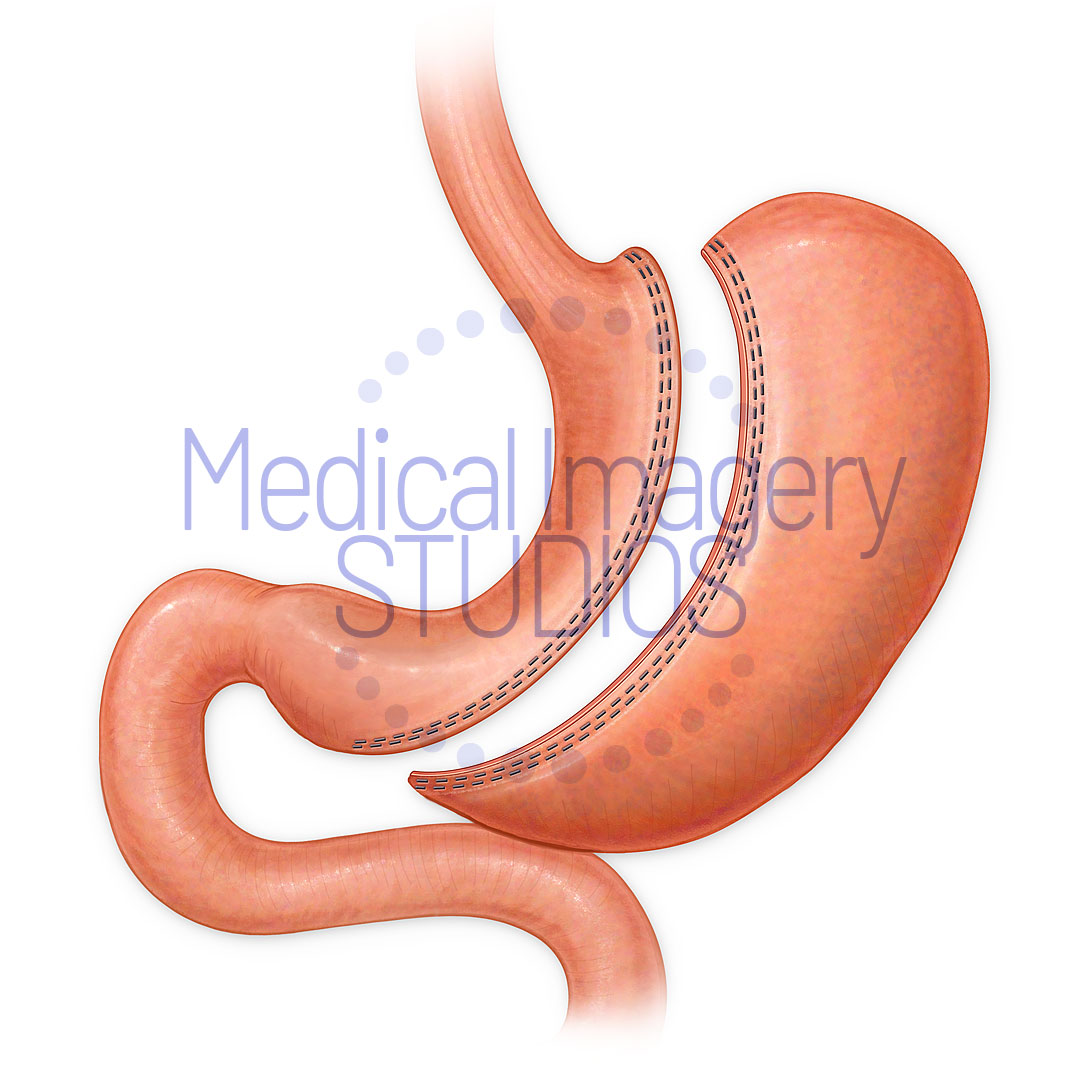 Sleeve Gastrectomy