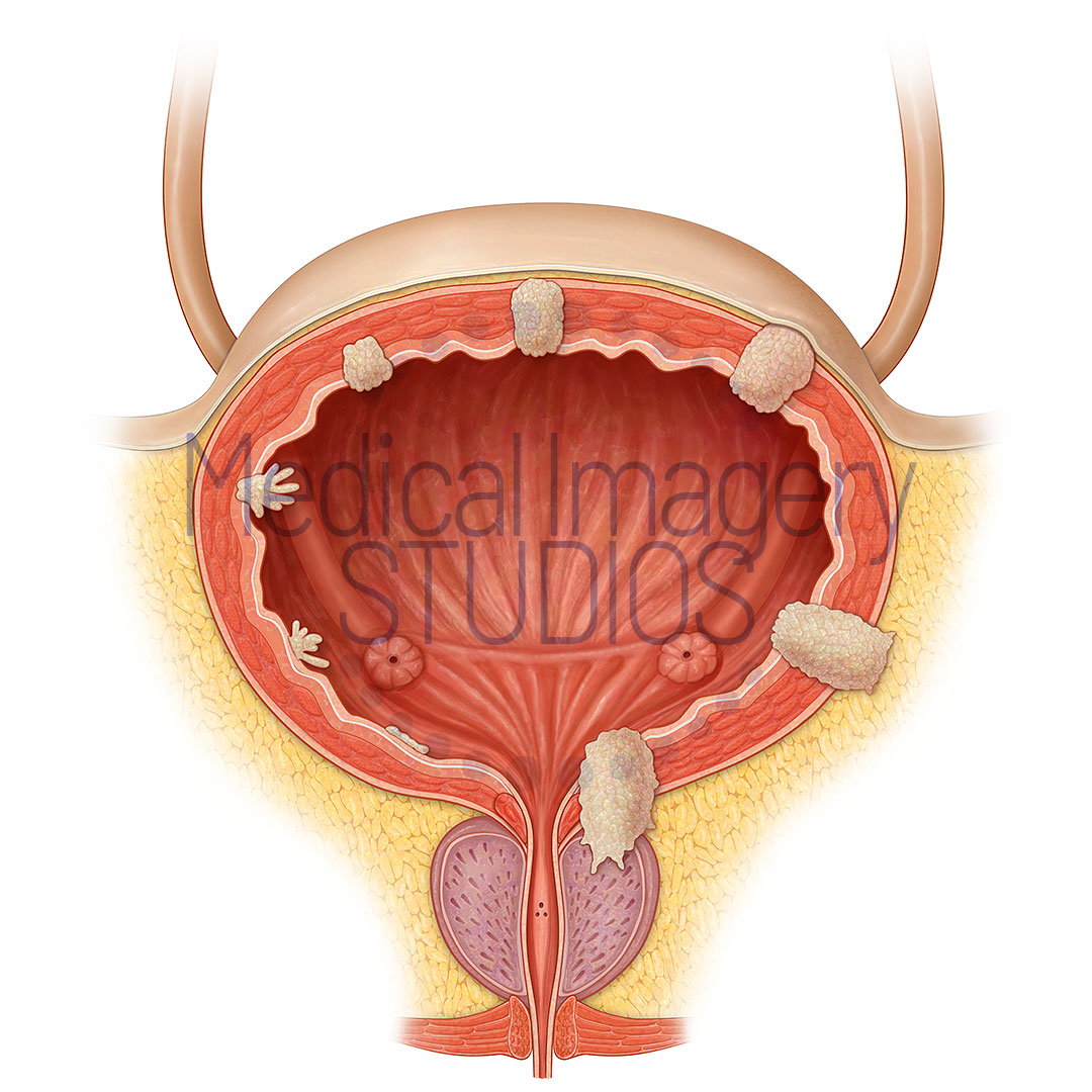 Stages of Bladder Cancer