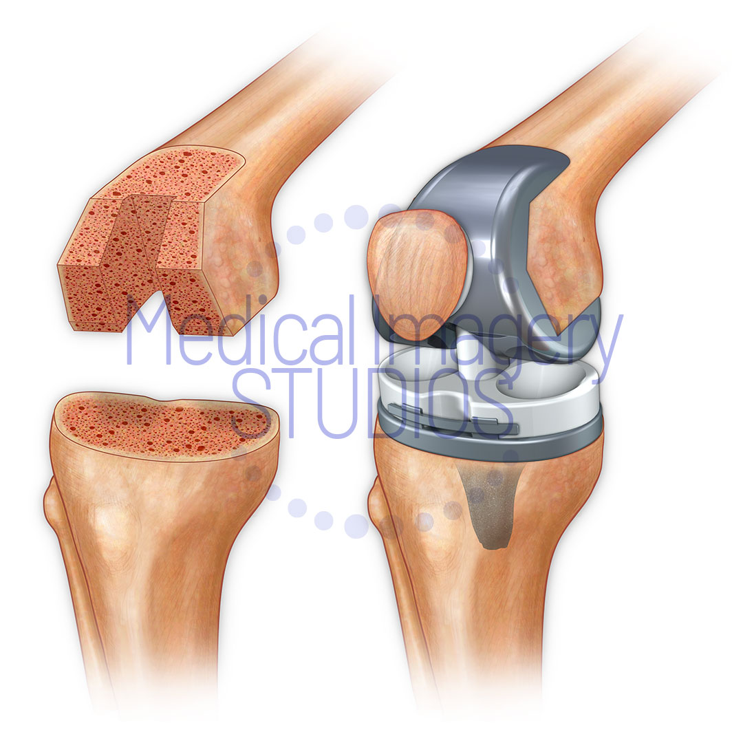 Total Knee Joint Arthroplasty
