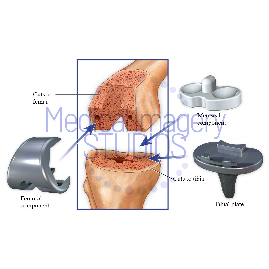 Total Knee Replacement Components