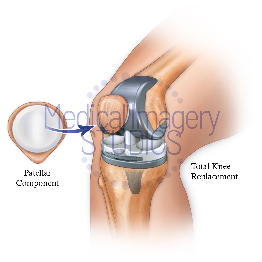 Total Knee Replacement 
