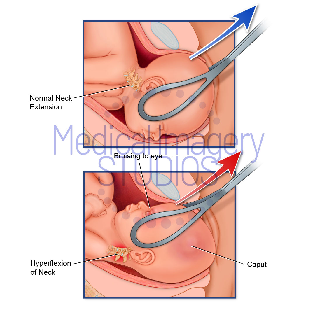 Traction of Baby's Head