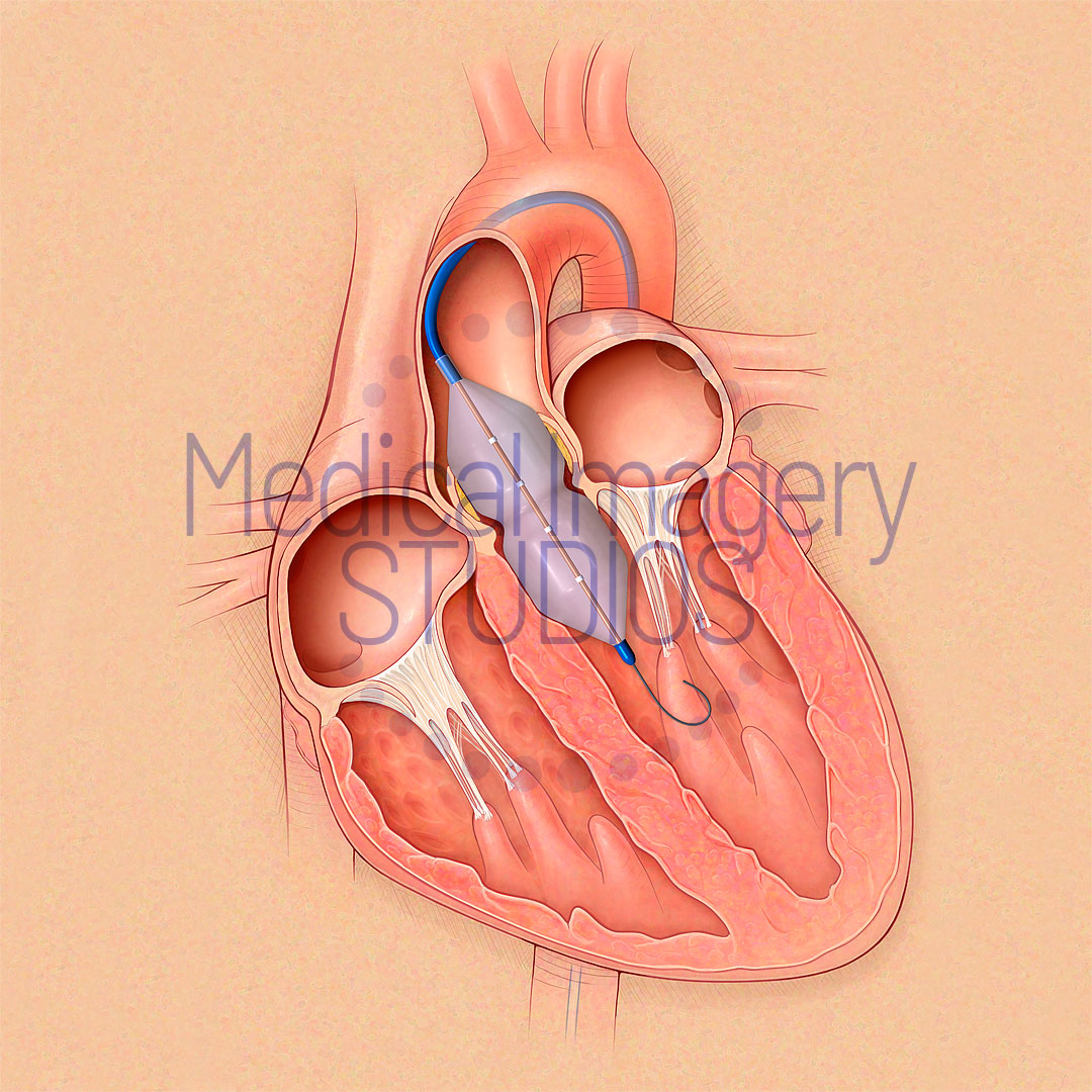 Valvuloplasty