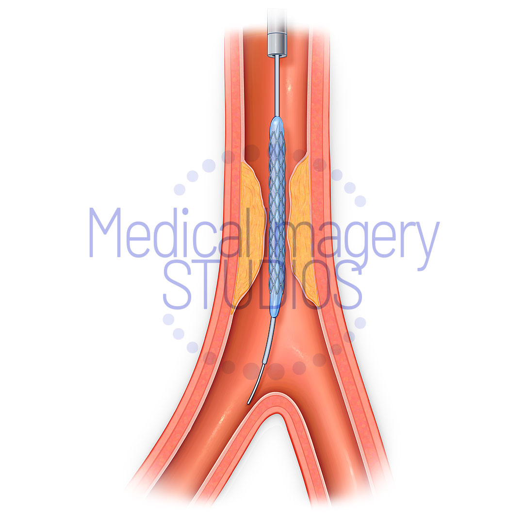 Vessel Balloon Stent