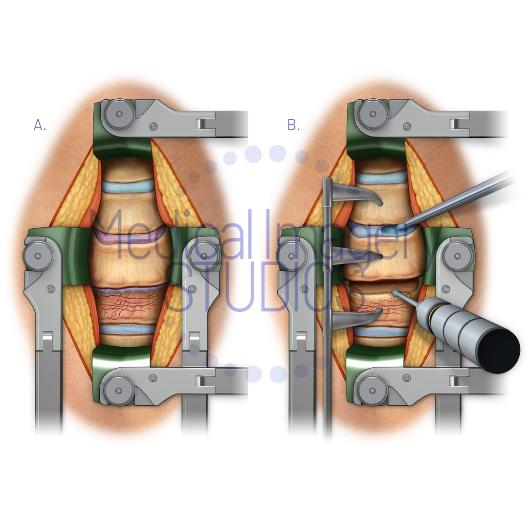 Anterior Spinal Fusion