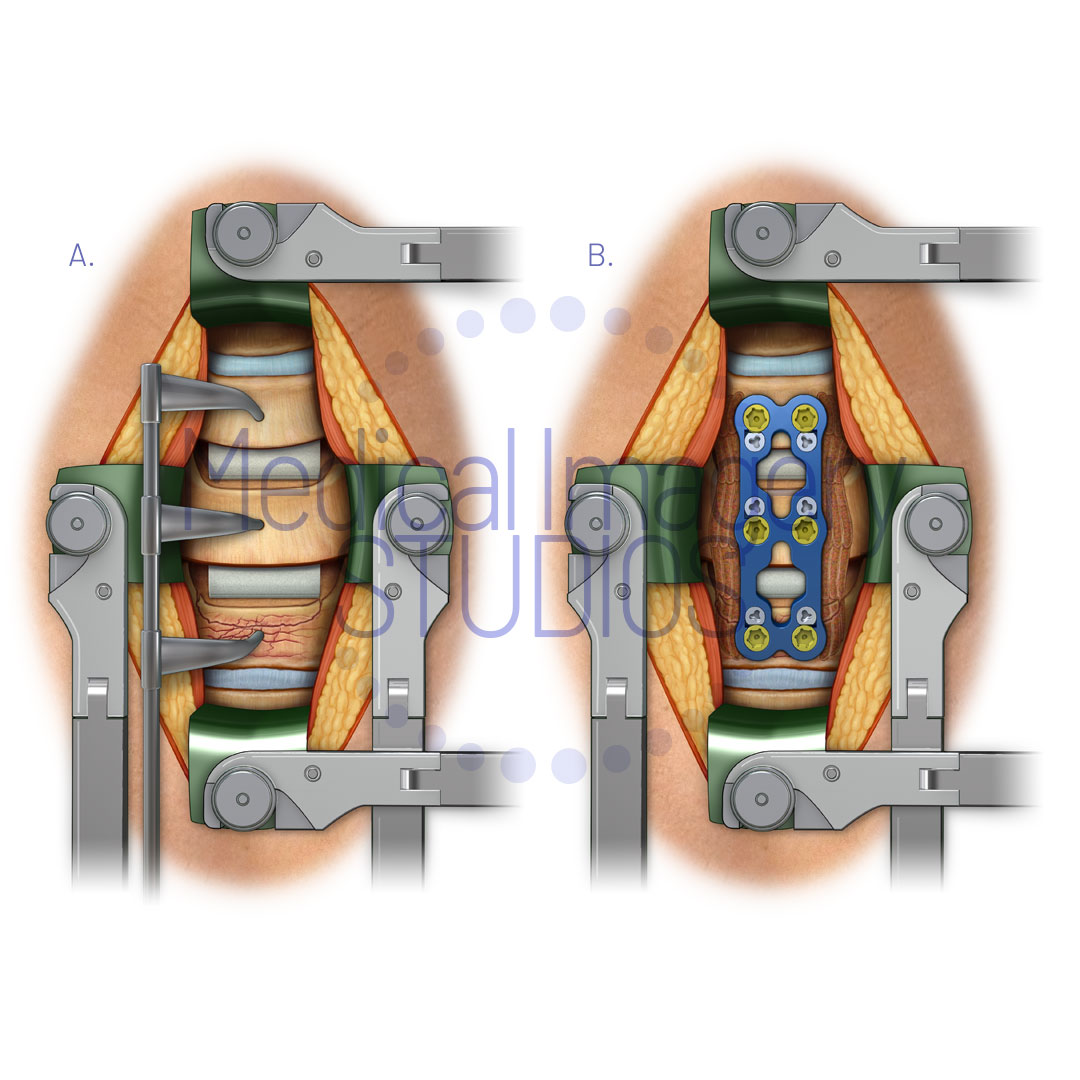 Anterior Spinal Fusion