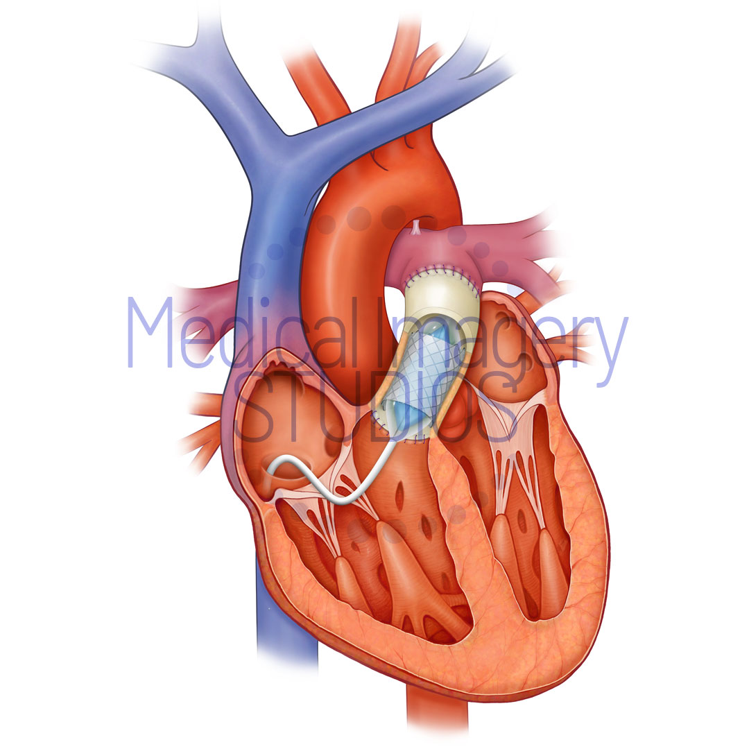 Heart BIB stent