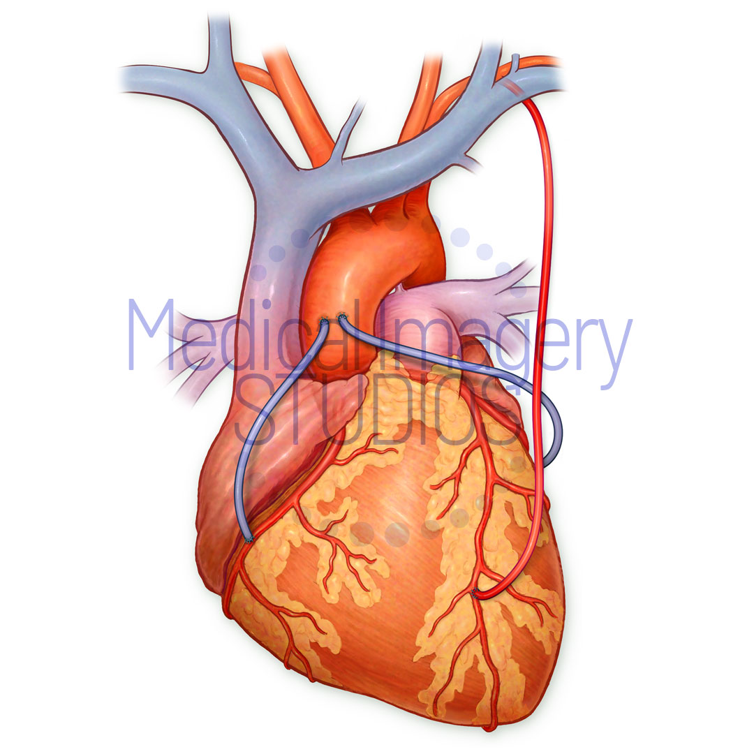 Heart Bypass
