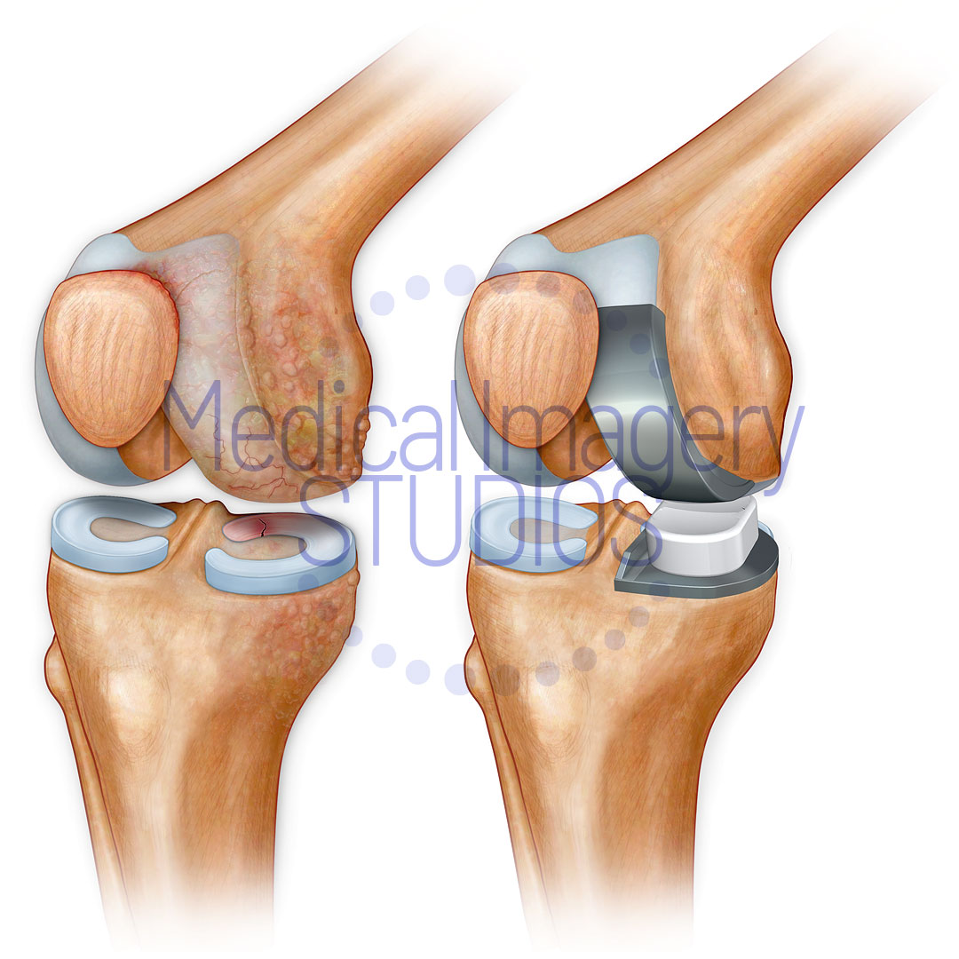 Knee Arthritis and Hemi-Replacement