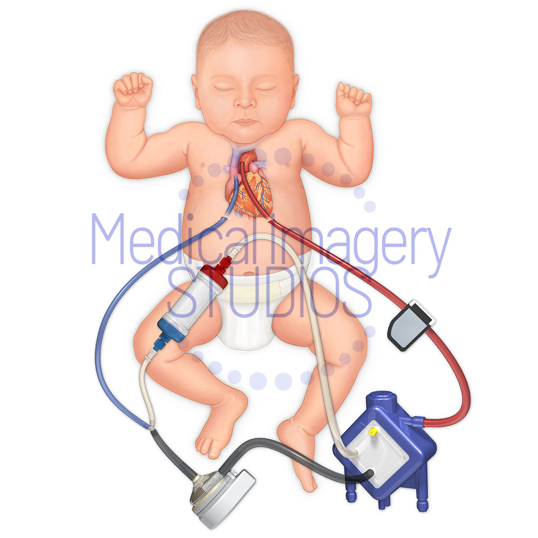 Pediatric Heart Pump Filter and Oxygen