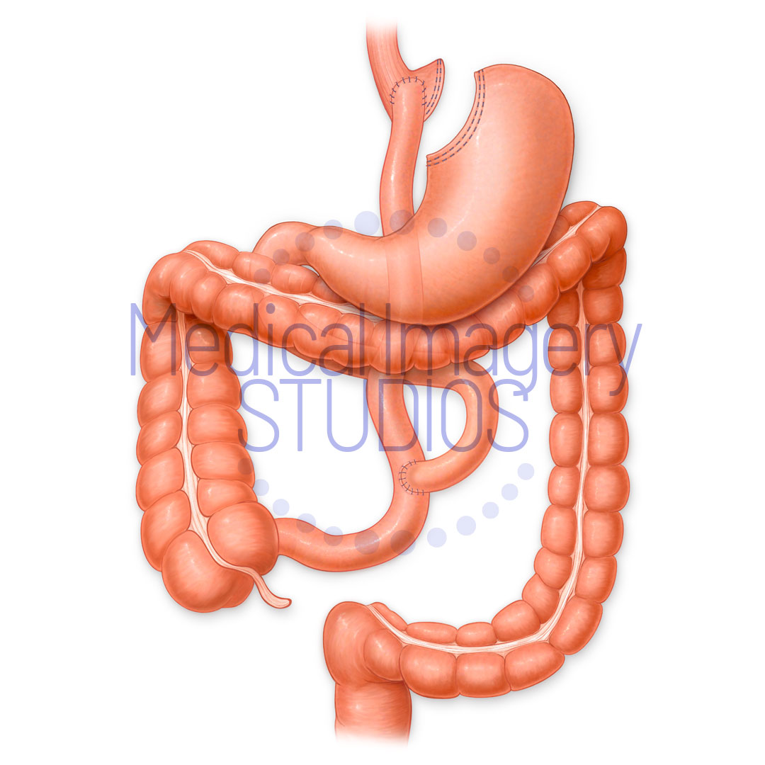 Stomach Bypass
