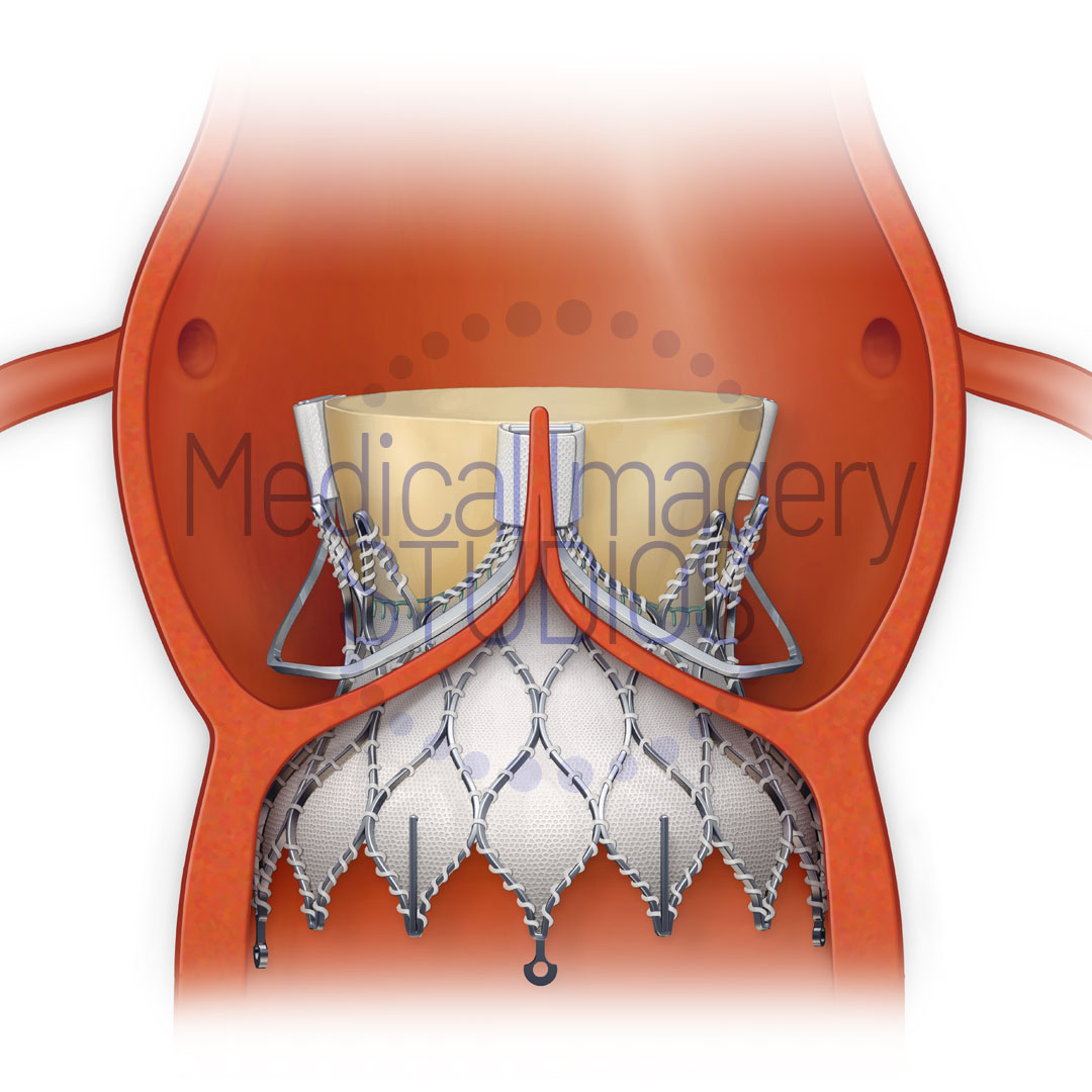 Transcatheter Aortic Valve