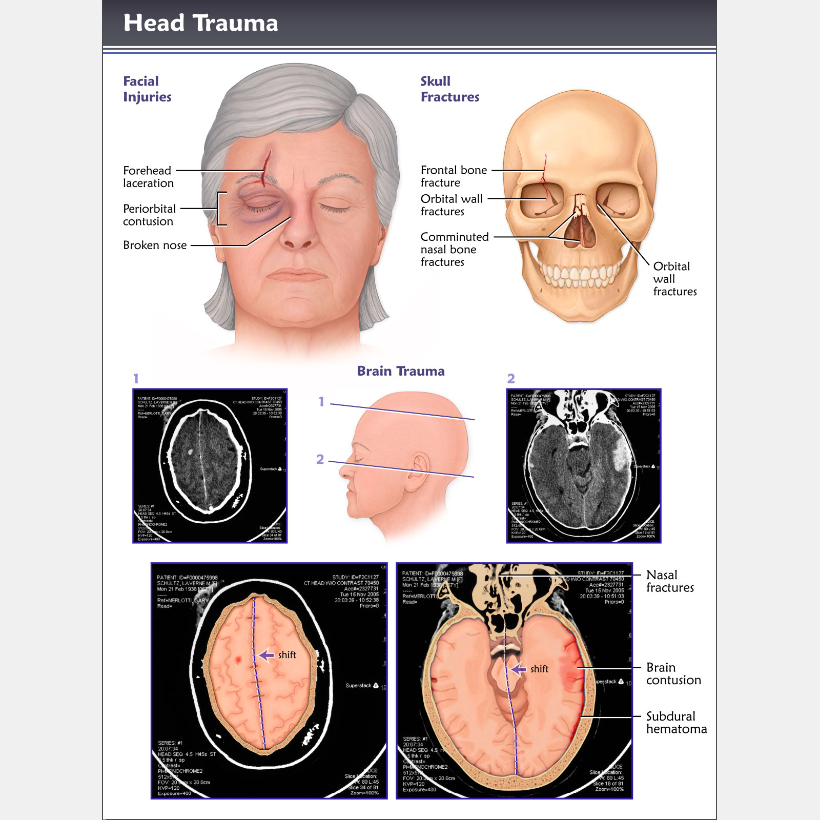 Head Trauma