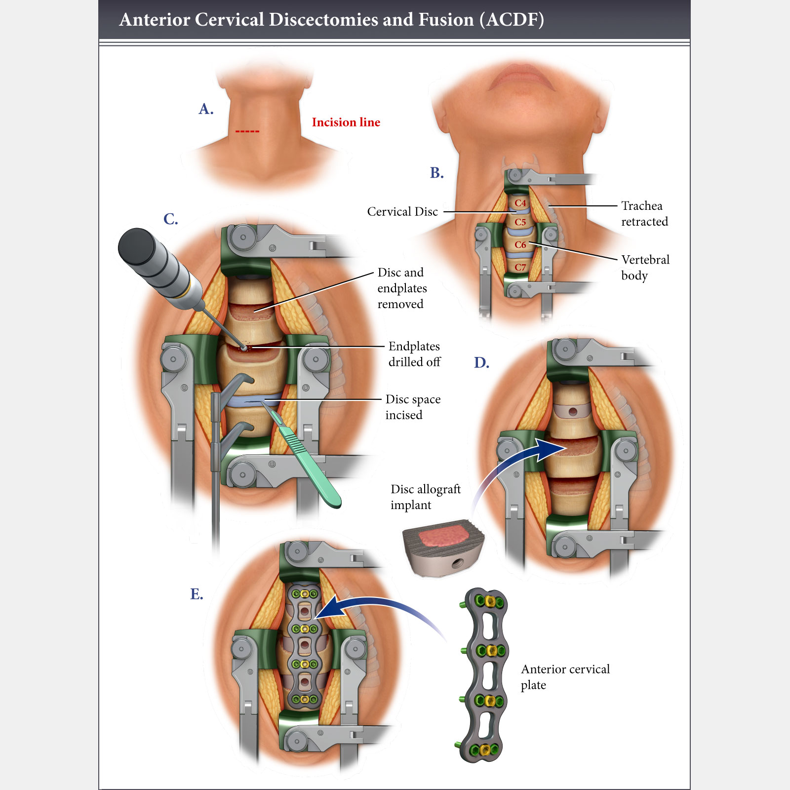 Anterior Cervical Discectomies & Fusion