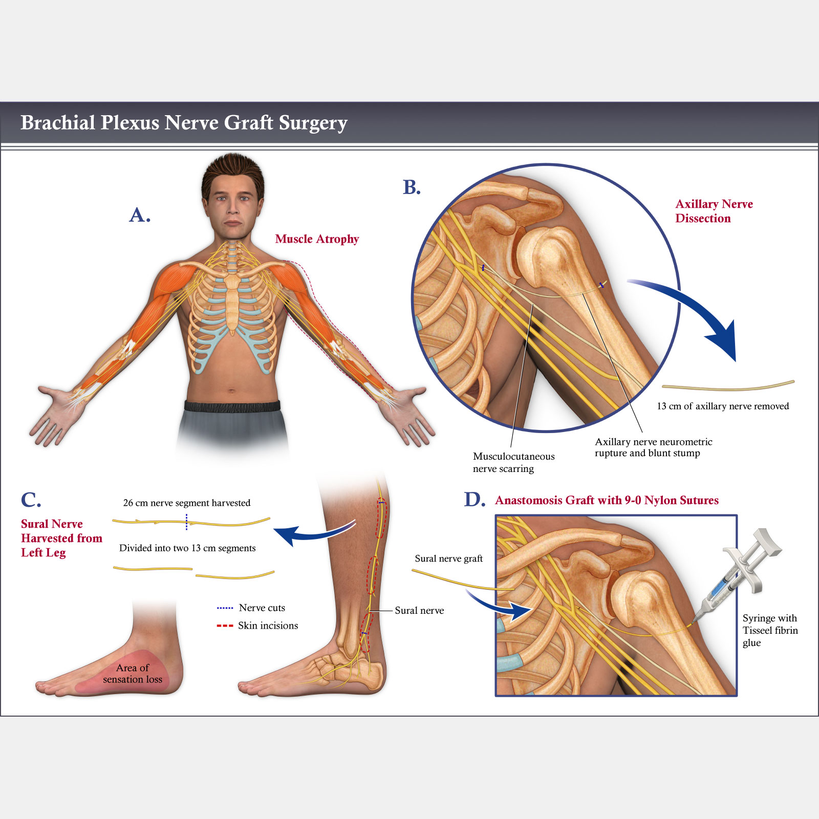Brachial Plexus Nerve Graft Surgery