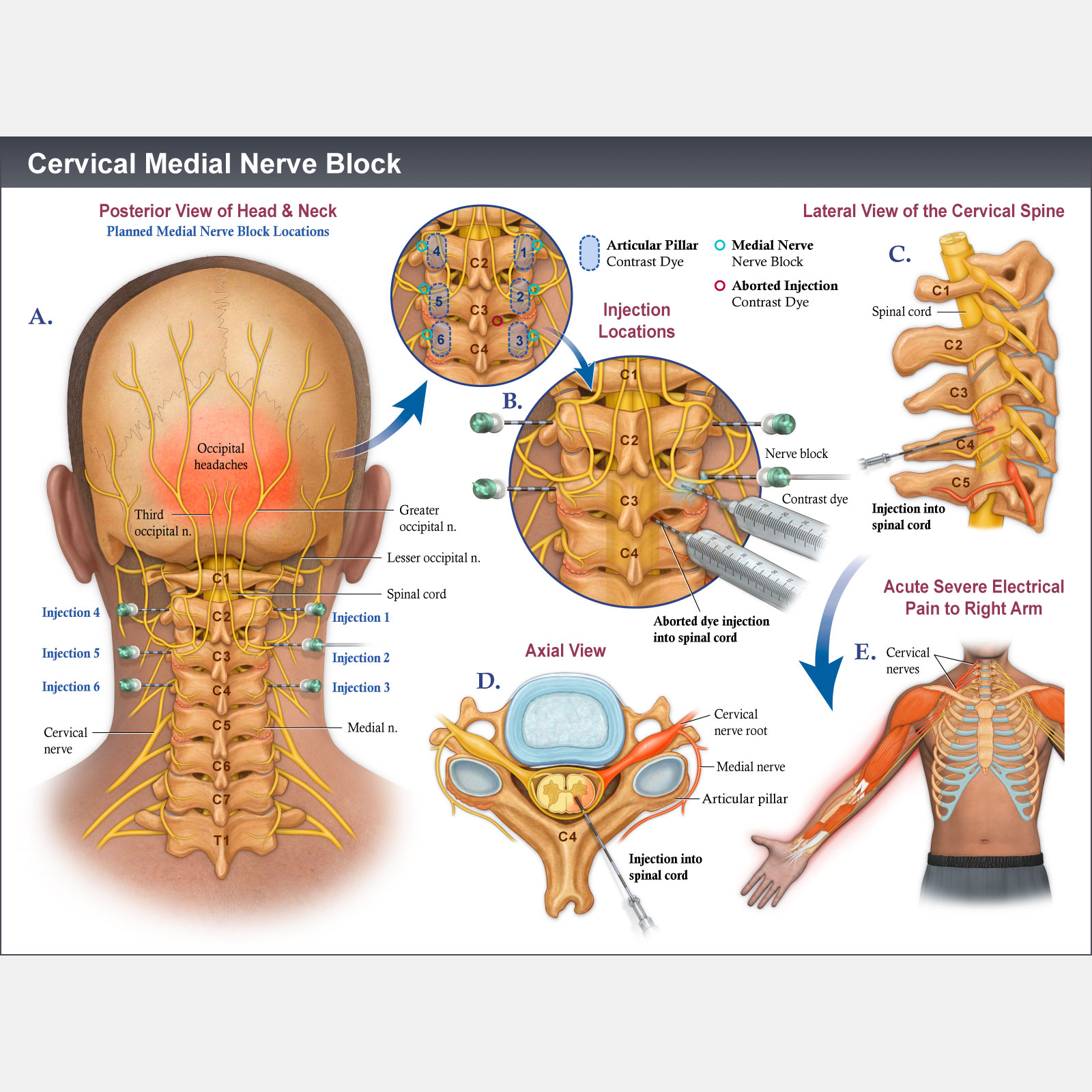 Cervical Medial Nerve Block