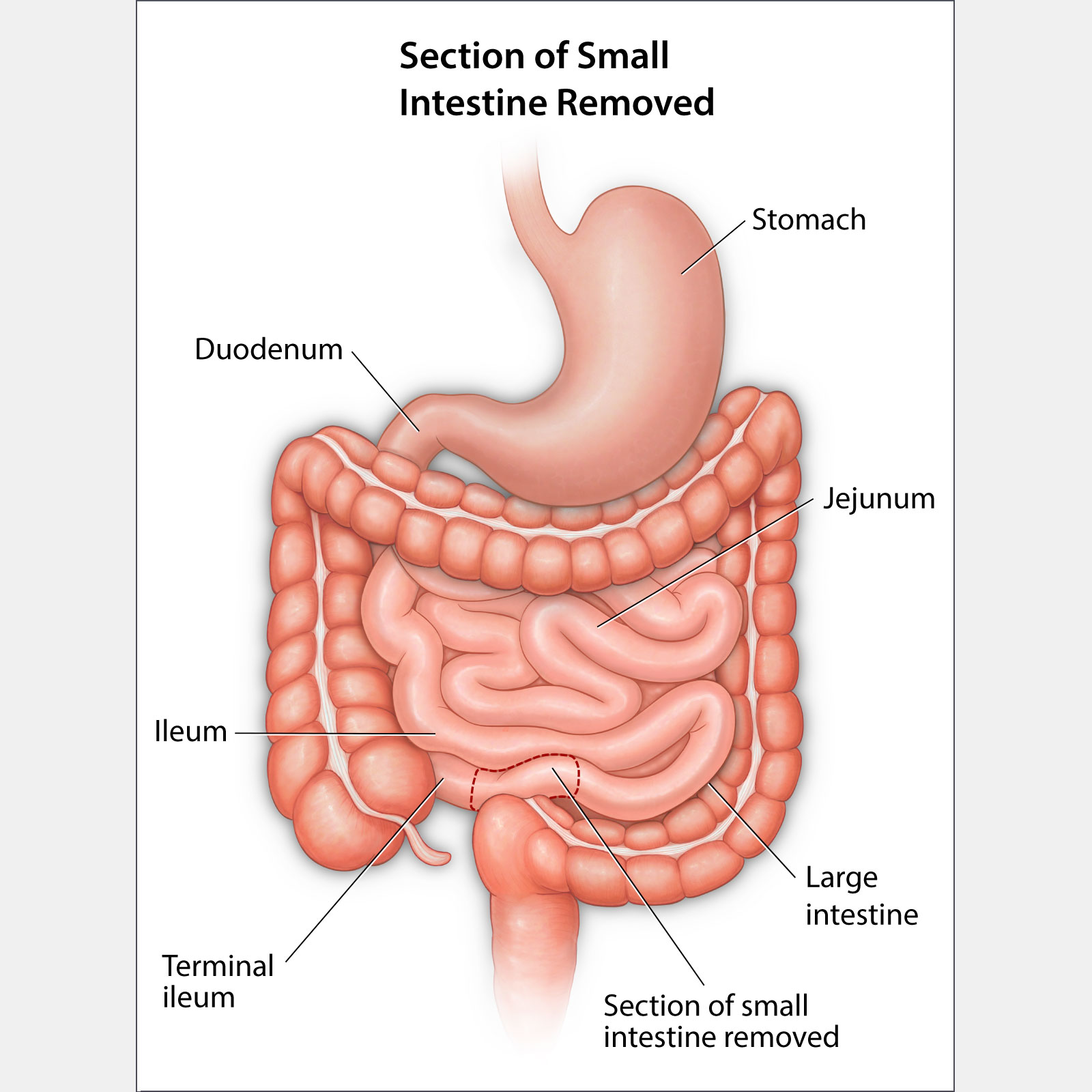 Section of Small Intestine Removed