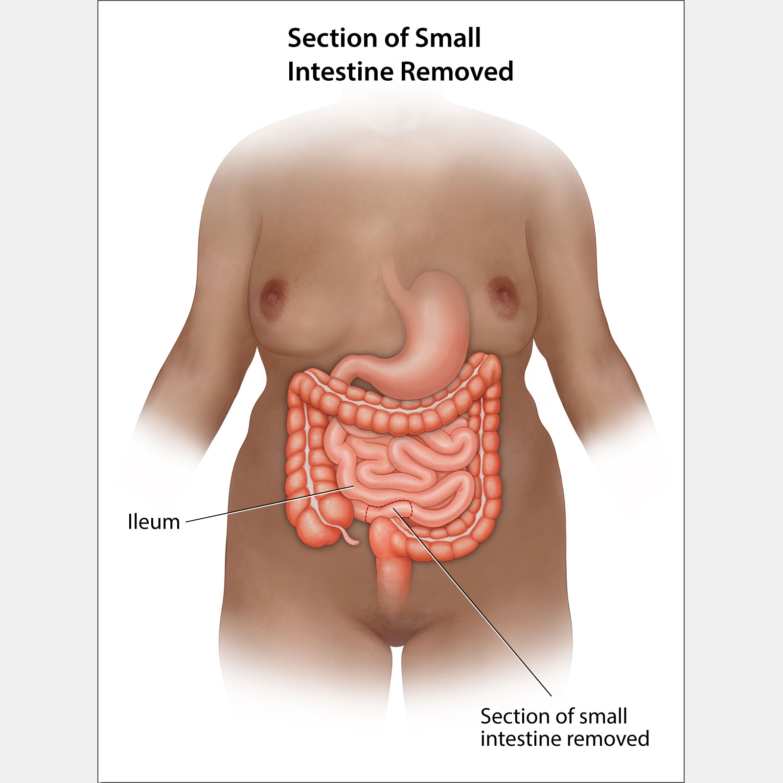 Section of Small Intestine Removed