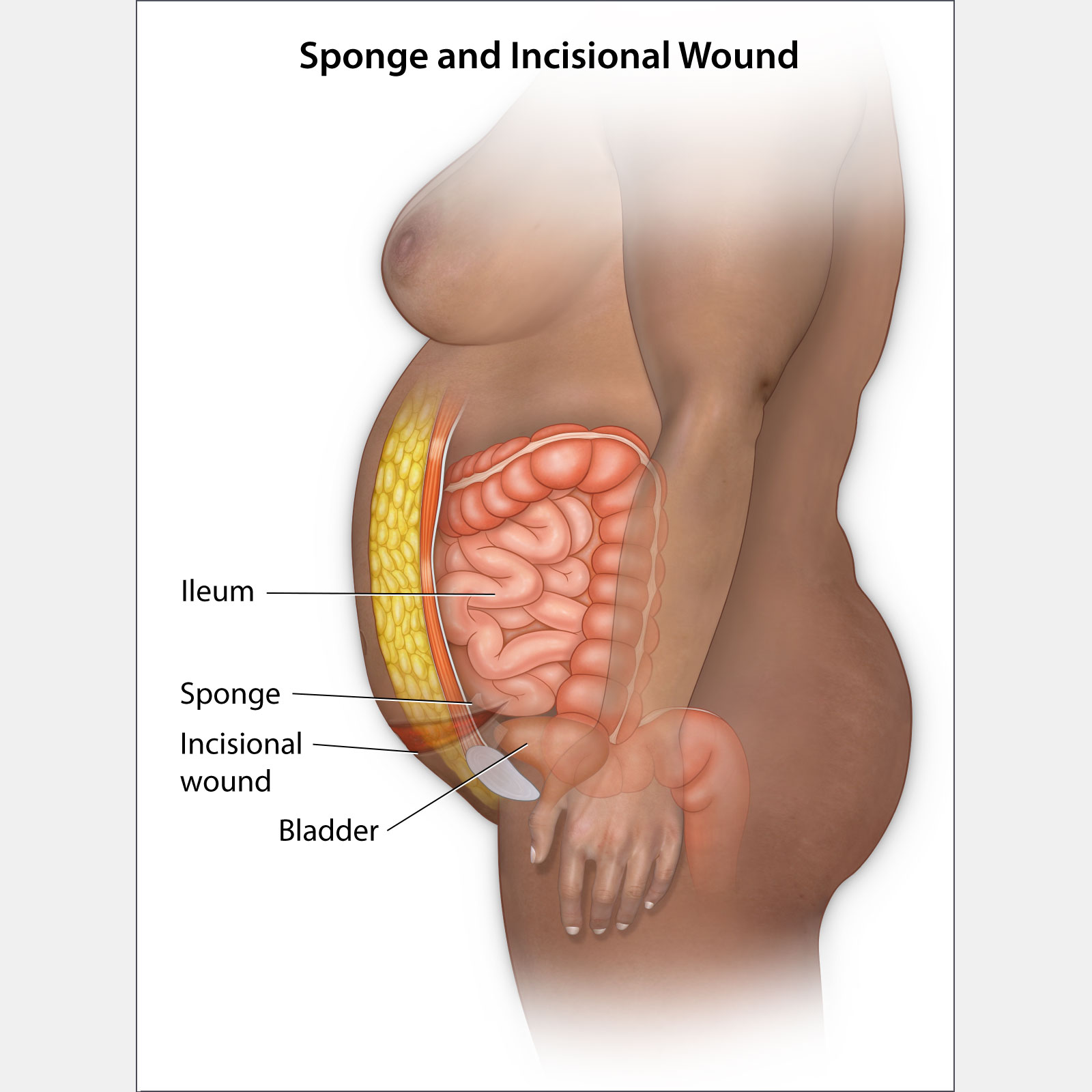 Sponge & Incisional Wound