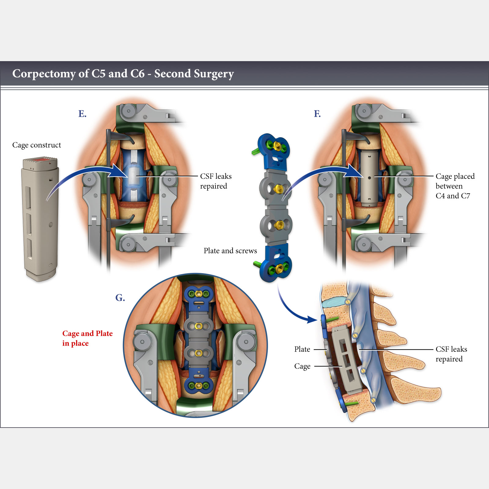 Corpectomy
