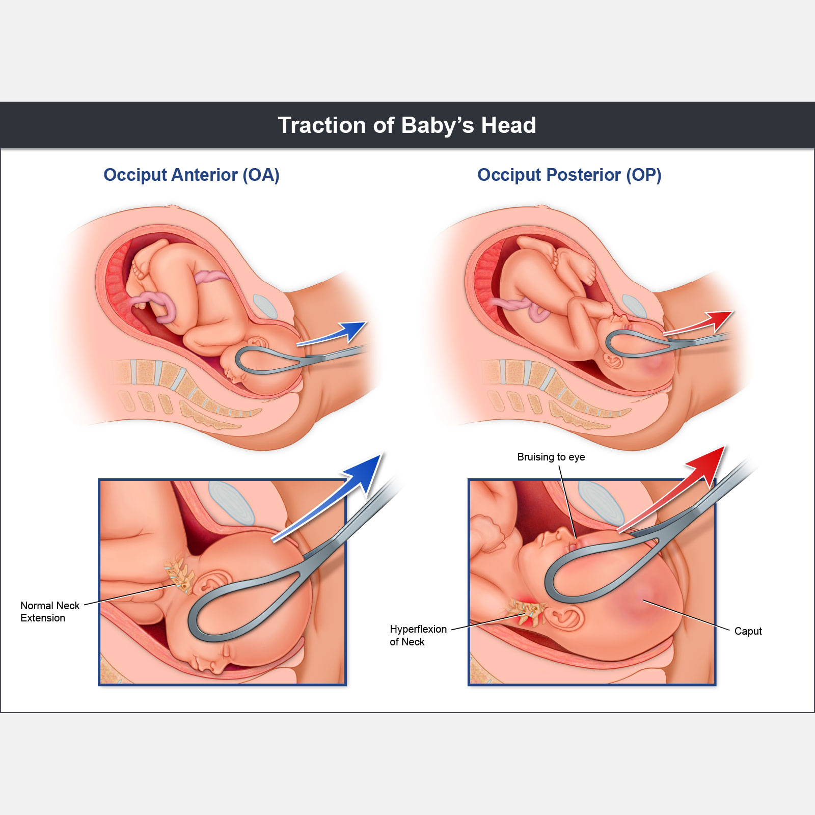 Traction of Babys Head