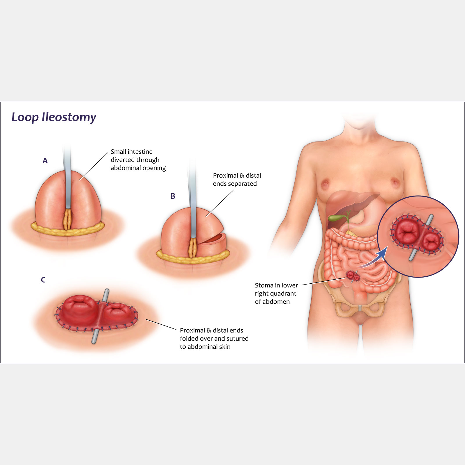 Loop Ileostomy