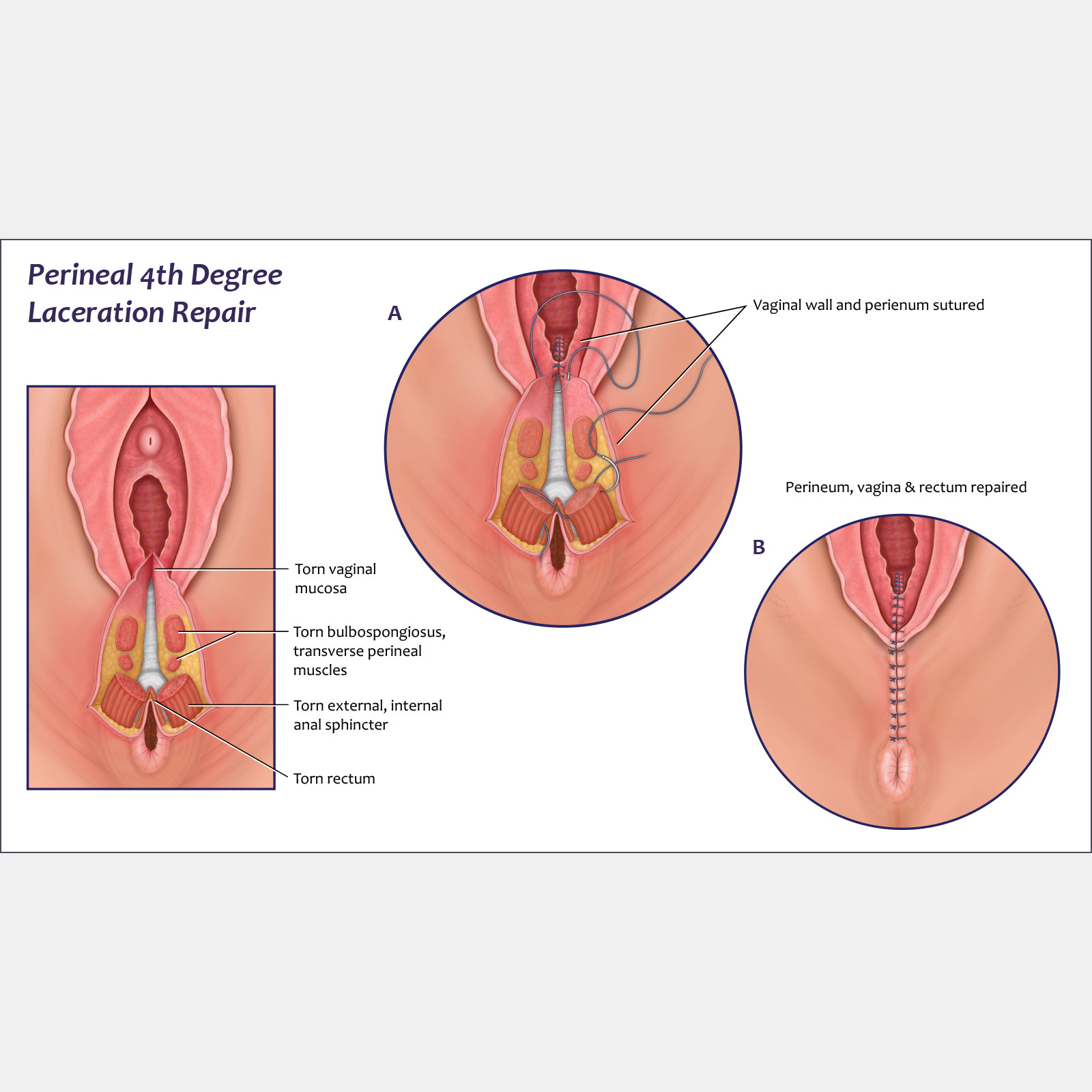 Perineal 4th Degree Laceration Repair