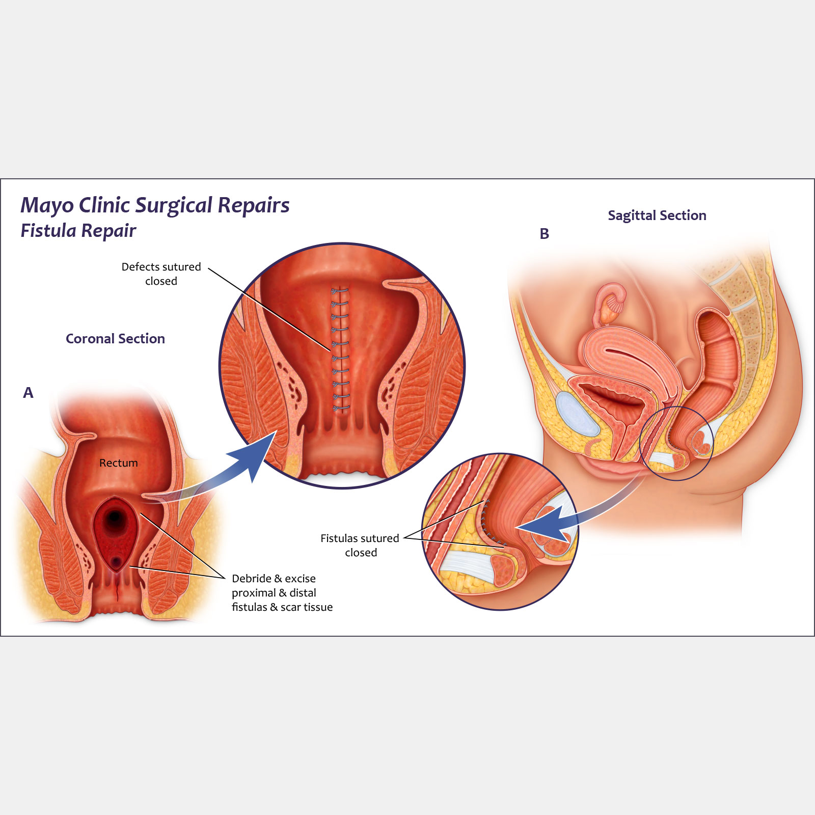 Surgical Repairs