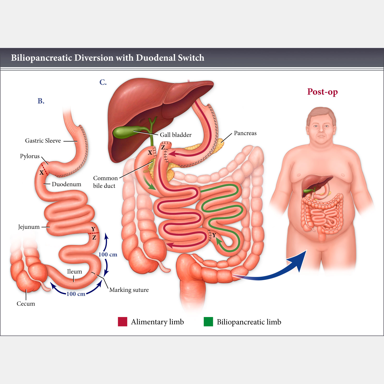 Biliopancreatic Diversion with Duodenal Switch